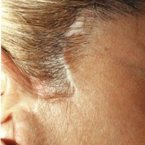 Dermopigmentation réparatrice cicatrices