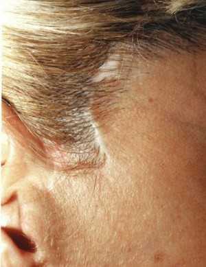 Dermopigmentation réparatrice cicatrices